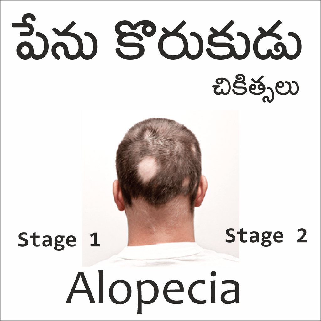 Best treatment for alopecia